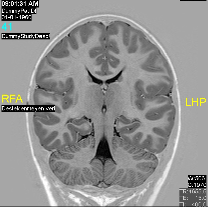 Rubinstein-Taybi syndrome  Radiology Reference Article