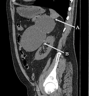 Features of Laparoscopic Adrenalectomy for Giant Adrenal CYST